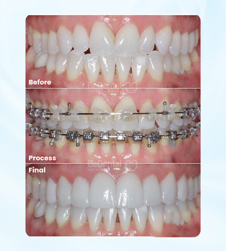 Braces in Vietnam: High-Quality Orthodontic Care for Confident & Healthy Smiles 5 niengrang 214