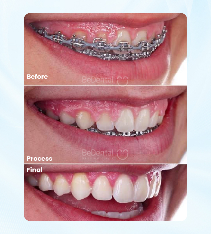 Braces Tightening in Vietnam