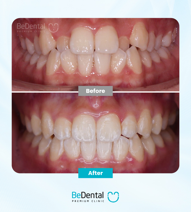 Does Braces Treatment Hurt in Vietnam? Does Braces Treatment Hurt in Vietnam? Does Braces Treatment Hurt in Vietnam?