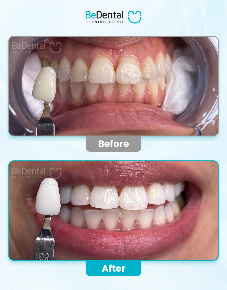 Teeth Whitening