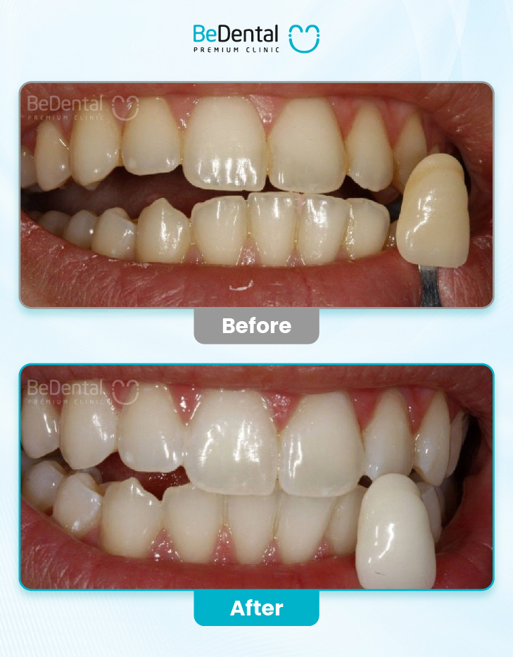 Teeth Whitening