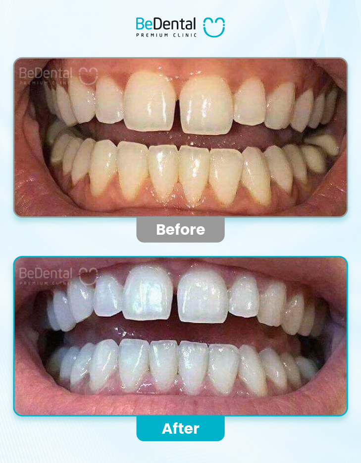 Teeth Whitening
