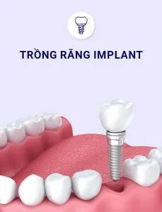 trong rang implan 229x300 1