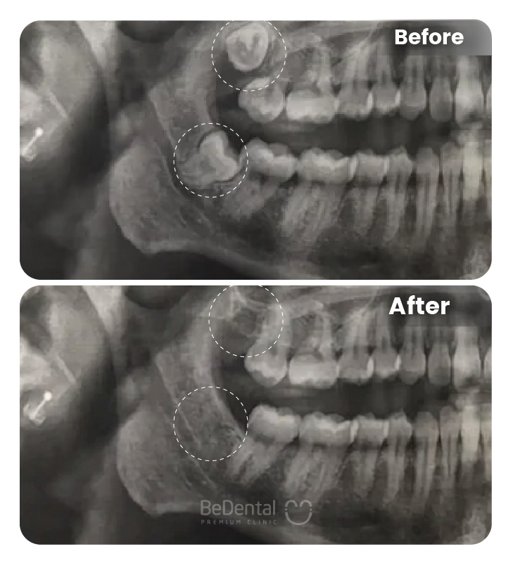 Wisdom Tooth Extraction