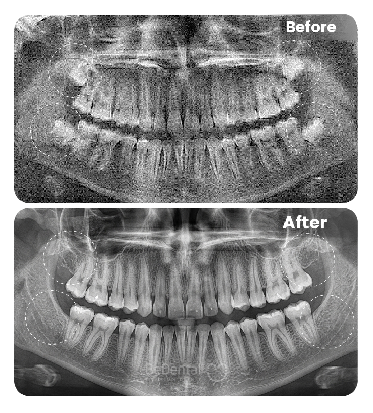 Wisdom Tooth Extraction