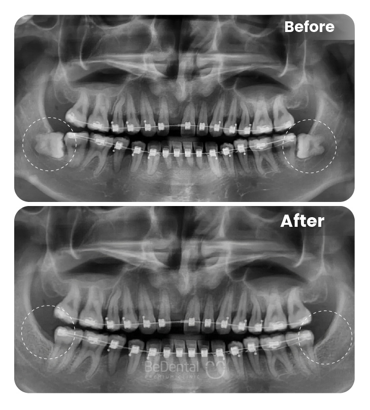 Răng Mọc Trên Nướu: Nguyên Nhân, Hậu Quả Và Giải Pháp Điều Trị 3 wisdom 203