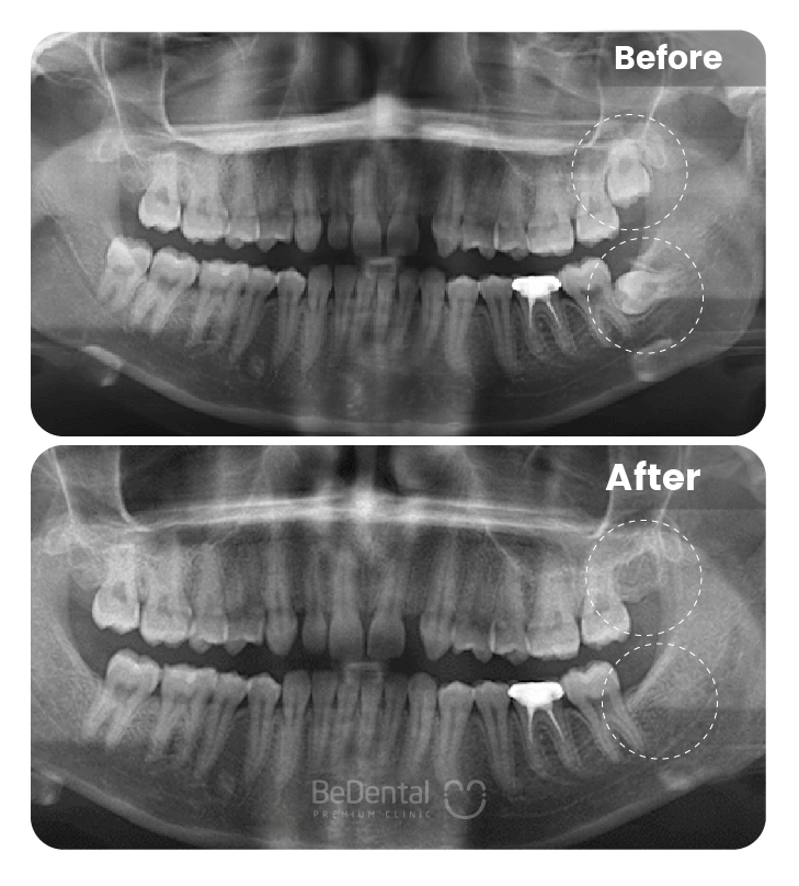 Wisdom Tooth Extraction