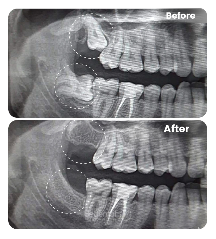 Răng khôn bị lợi trùm: Nguyên nhân và giải pháp điều trị hiệu quả tại BeDental 4 Wisdom Tooth Pain in Vietnam. Wisdom Tooth Pain in Vietnam. Wisdom Tooth Pain in Vietnam