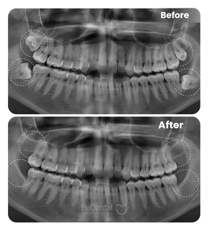 Wisdom Tooth Extraction
