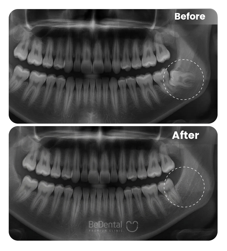 Decayed Wisdom Teeth in Vietnam