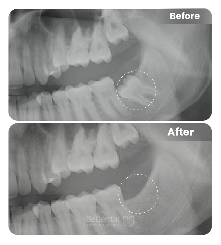Wisdom Tooth Extraction