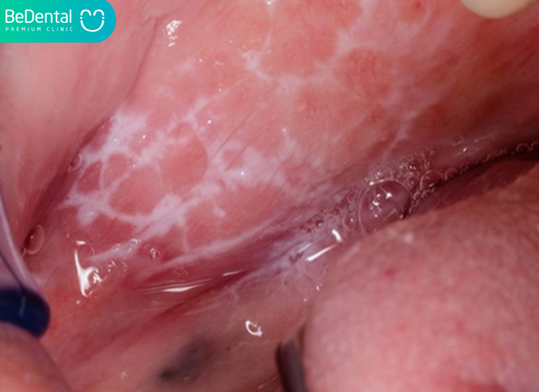 lớp màng nhầy màu trắng bên trong miệng