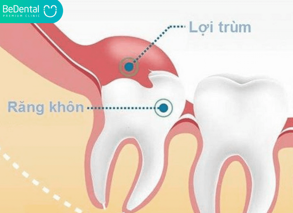 Răng Khôn Bị Lợi Trùm