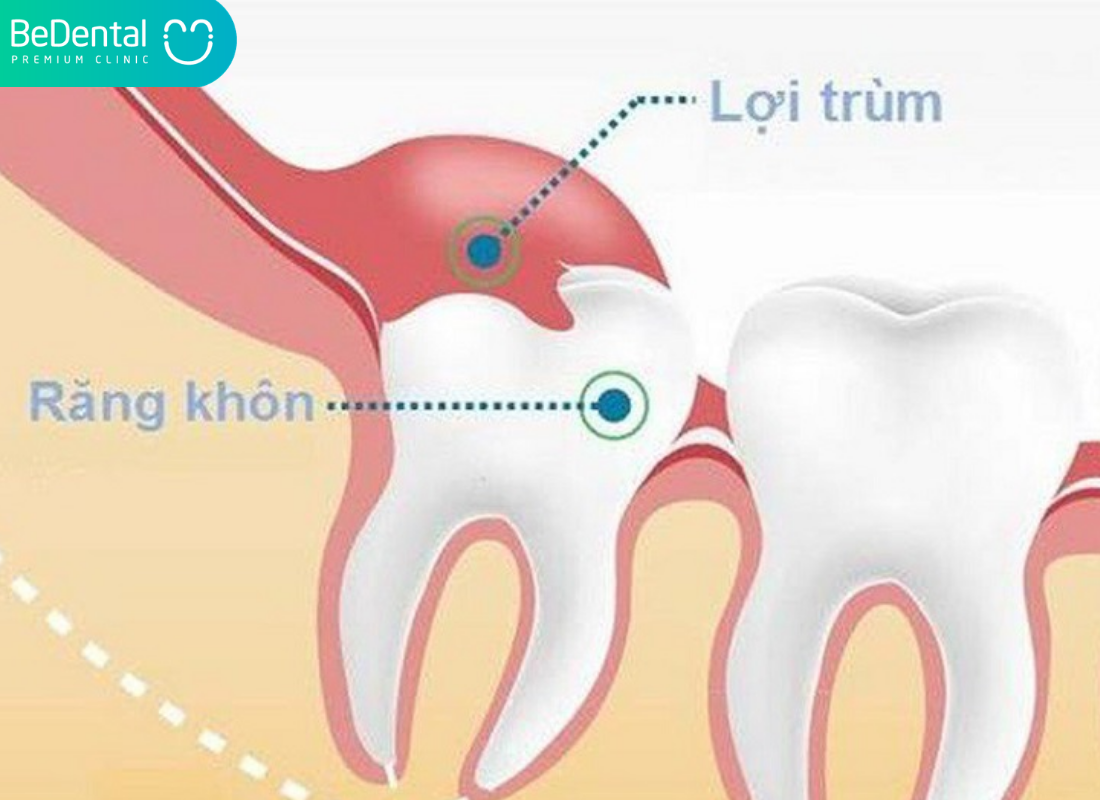 Răng Khôn Bị Lợi Trùm