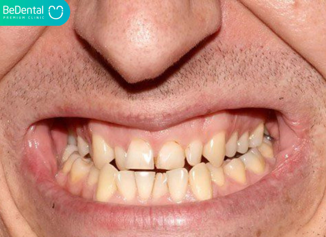 Răng quặp là gì?