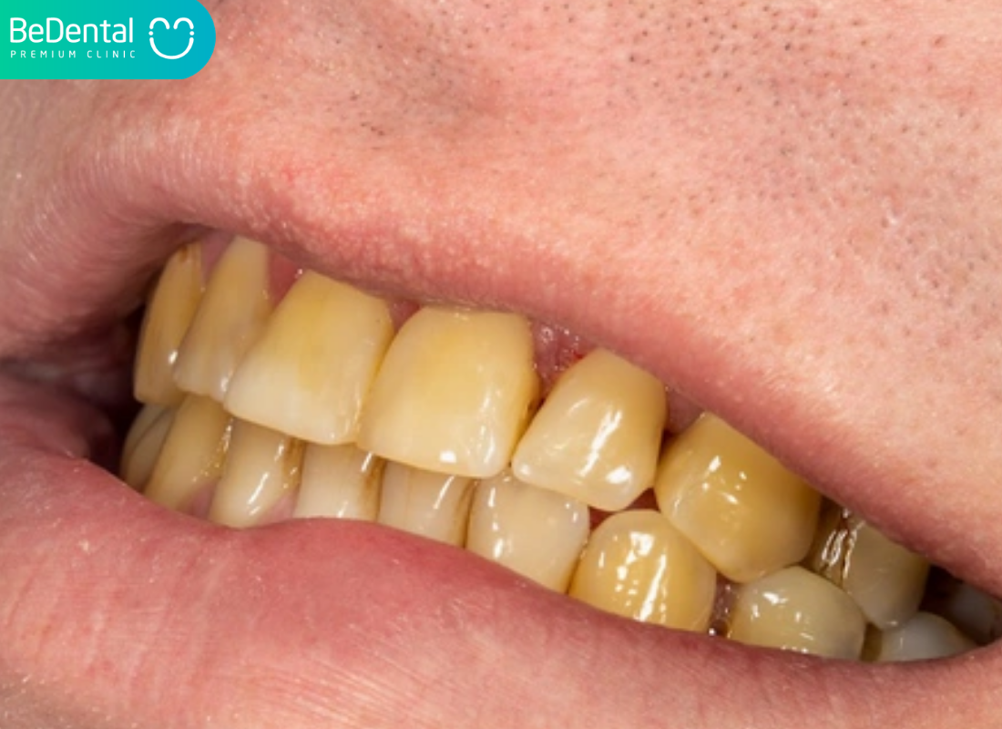 răng bị xỉn màu