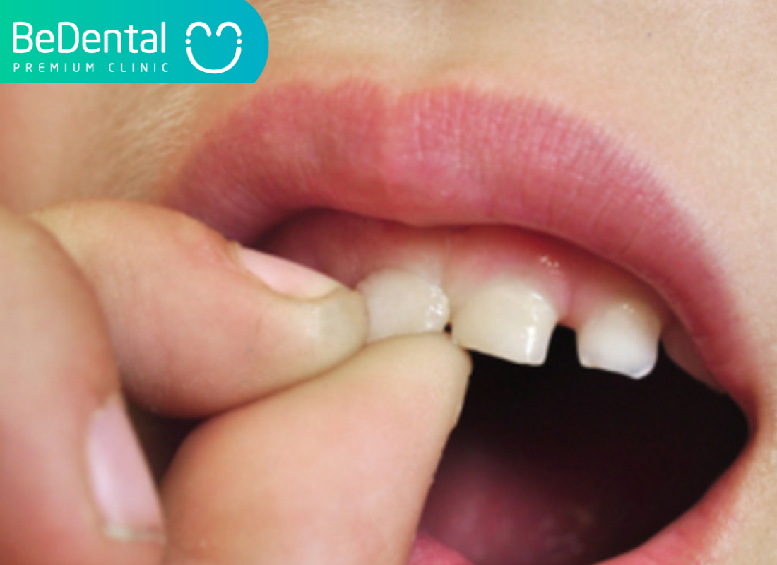 Răng cửa lung lay là gì?