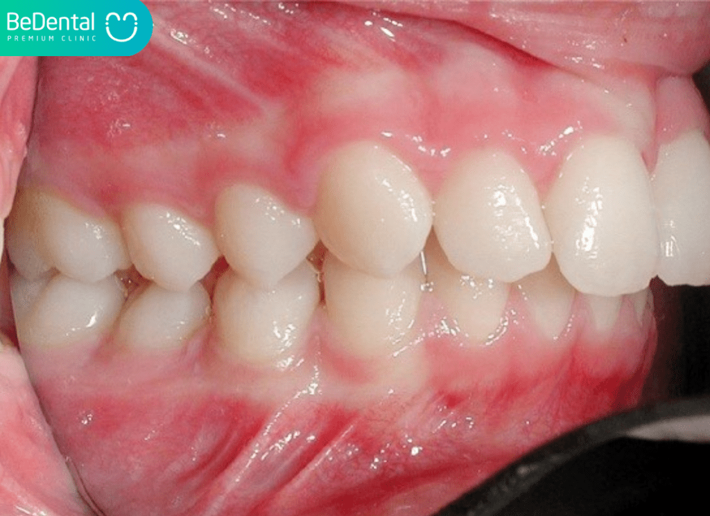 Răng hô có nên niềng răng không? Những điều bạn cần biết trước khi chỉnh nha 3 Răng hô có nên niềng răng không?