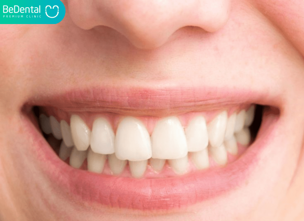 Răng hô nhẹ: Nguyên nhân, dấu hiệu và các giải pháp điều trị hiệu quả nhất 3 Răng hô nhẹ là gì