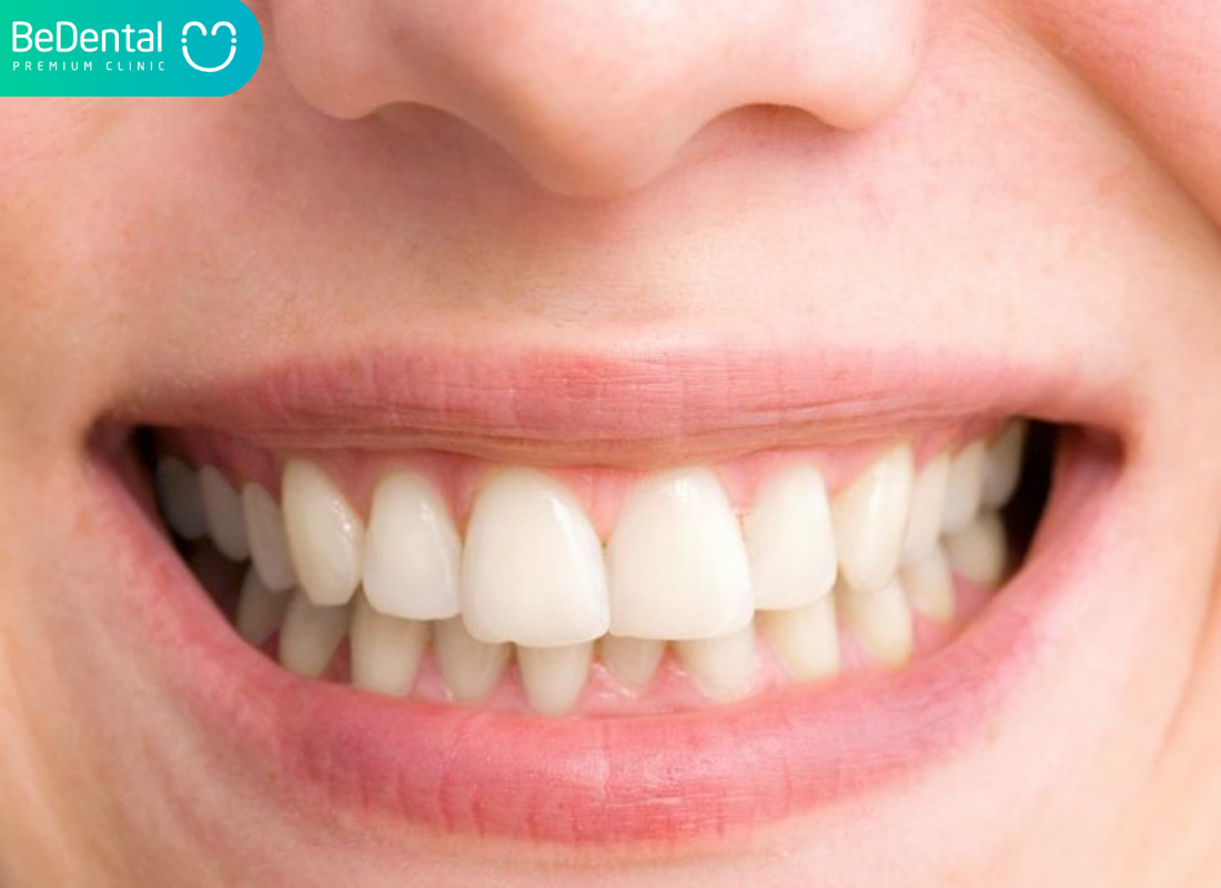 Răng hô nhẹ là gì