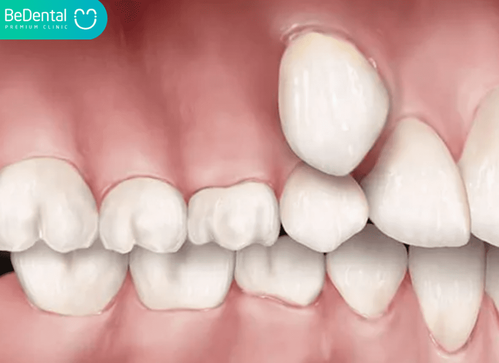 răng mọc trên nướu