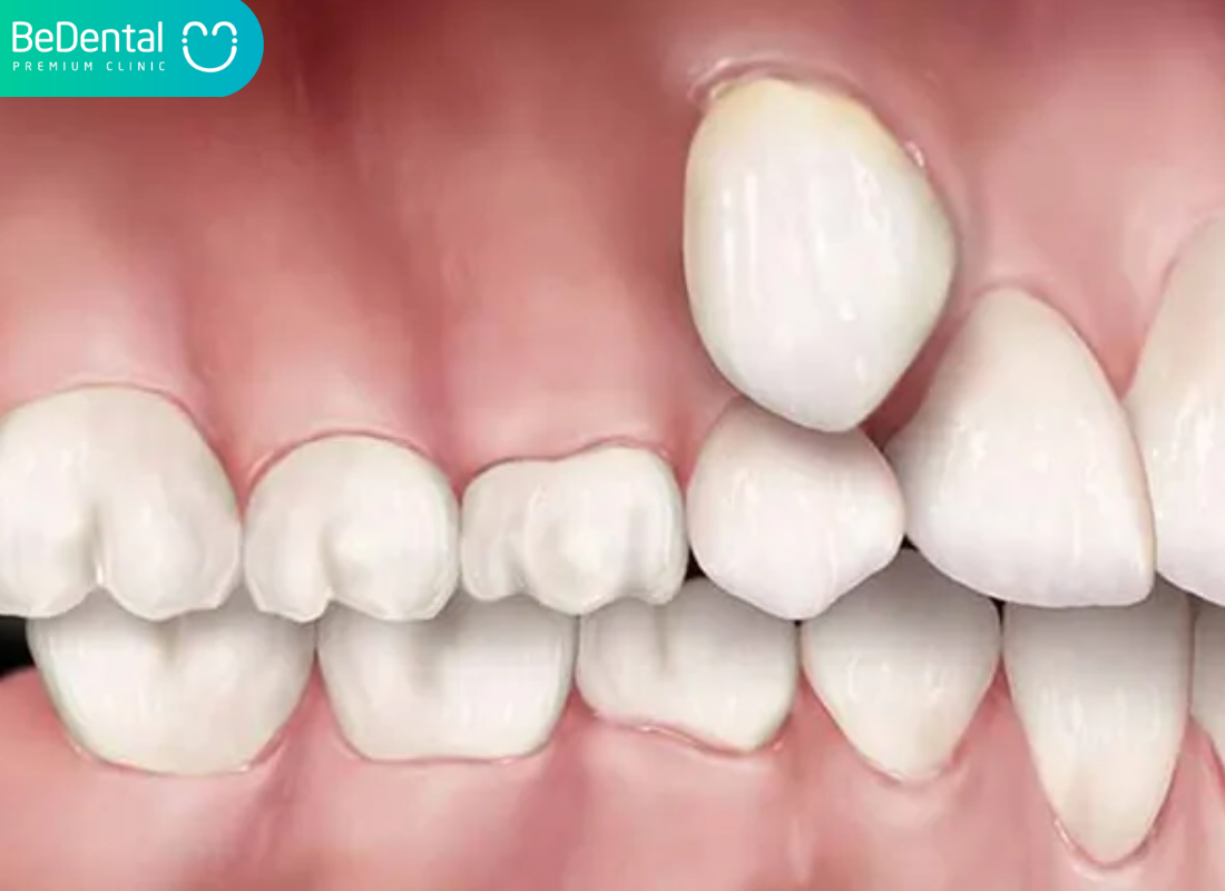 răng mọc trên nướu