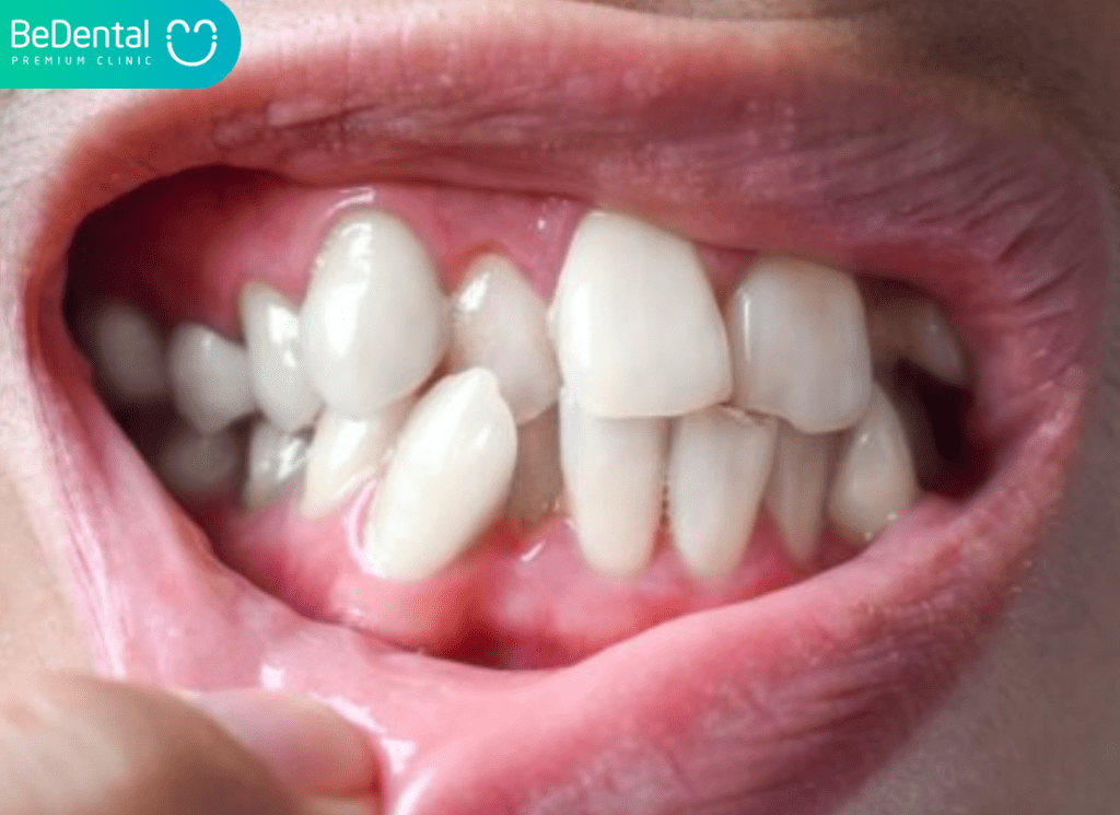 Thế nào là răng mọc lộn xộn