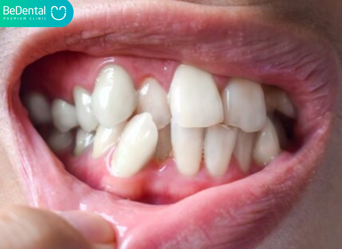 Thế nào là răng mọc lộn xộn