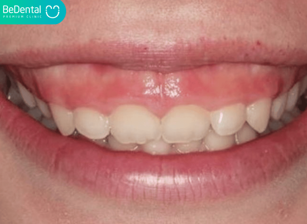 Thế nào là răng ngắn