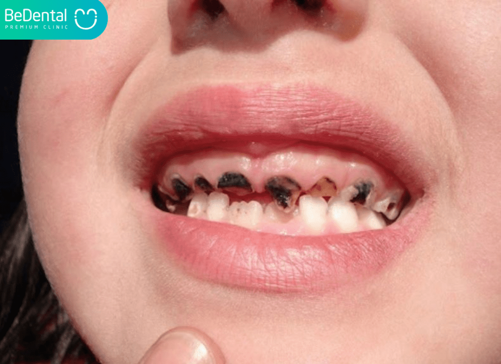 răng bé bị mảng bám đen