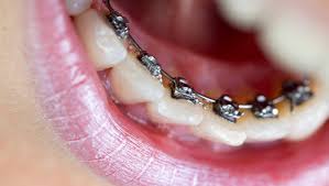 Braces in Vietnam: High-Quality Orthodontic Care for Confident & Healthy Smiles 3 Braces in Vietnam. Braces in Vietnam. Braces in Vietnam. Braces in Vietnam. Braces in Vietnam