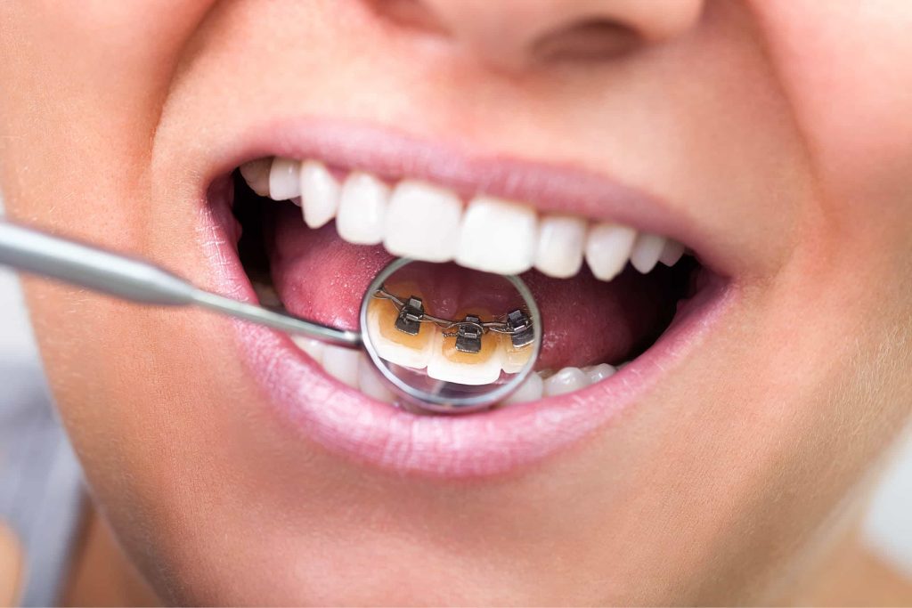 Can Braces Cause Tooth Loss in Vietnam? 2 Lingual Braces in Vietnam