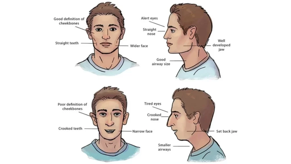 Malocclusion Treatment in Vietnam: Causes, Methods, and Cost 8 Malocclusion Treatment in Vietnam. Malocclusion Treatment in Vietnam. Malocclusion Treatment in Vietnam