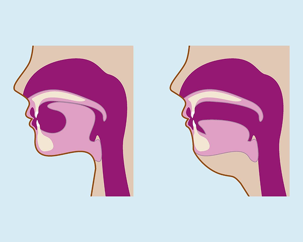 Can Patients with a Crossbite Practice Mewing in Vietnam? Can Patients with a Crossbite Practice Mewing in Vietnam?