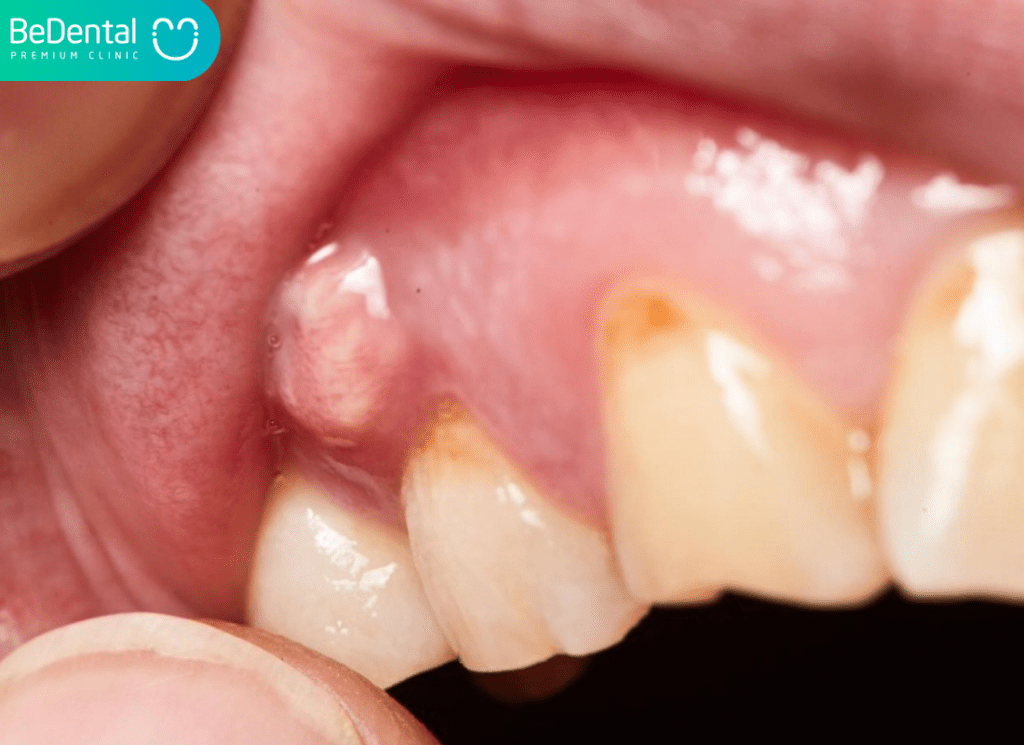 sưng nướu răng hàm trên