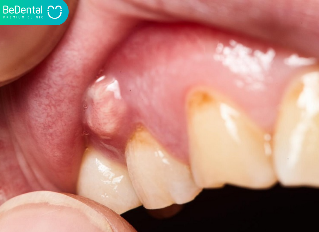 sưng nướu răng hàm trên