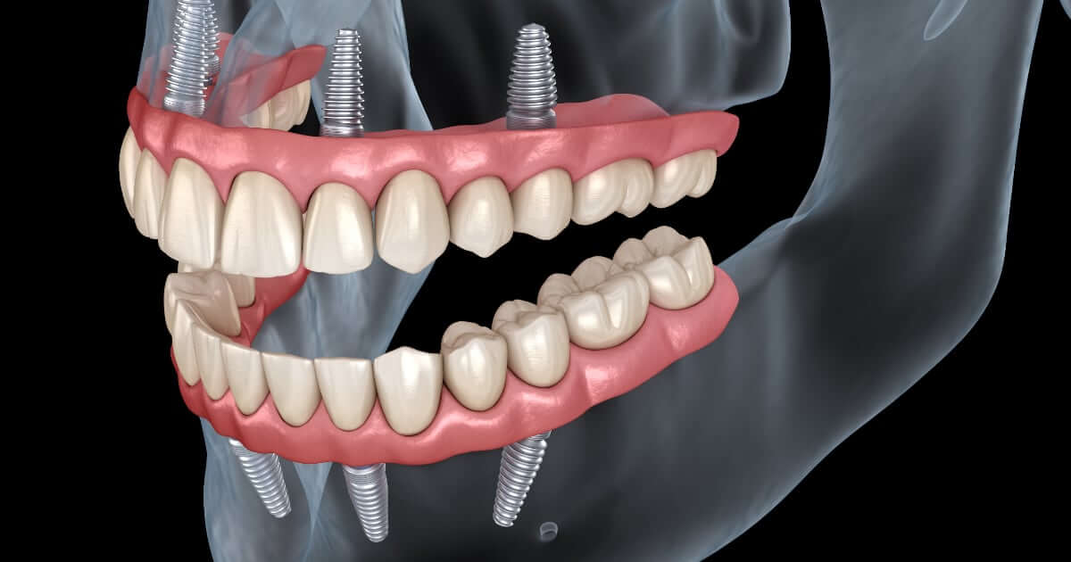phục hình implant toàn hàm all-on-4