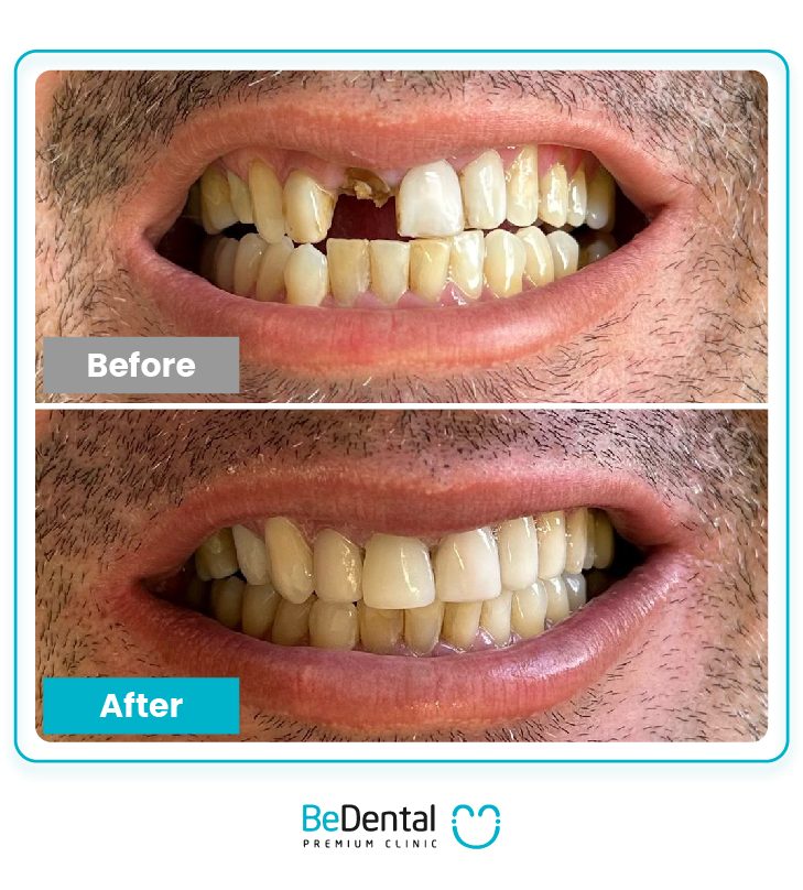 1implant 144