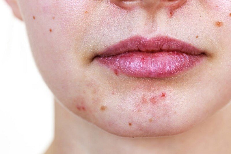Mụn Và Sức Khỏe Răng Miệng: Mối Liên Hệ Khoa Học Và Cách Chăm Sóc Đúng 5 mụn và sức khỏe răng miệng liệu có liên quan