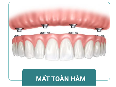 phục hình implant toàn hàm all-on-4