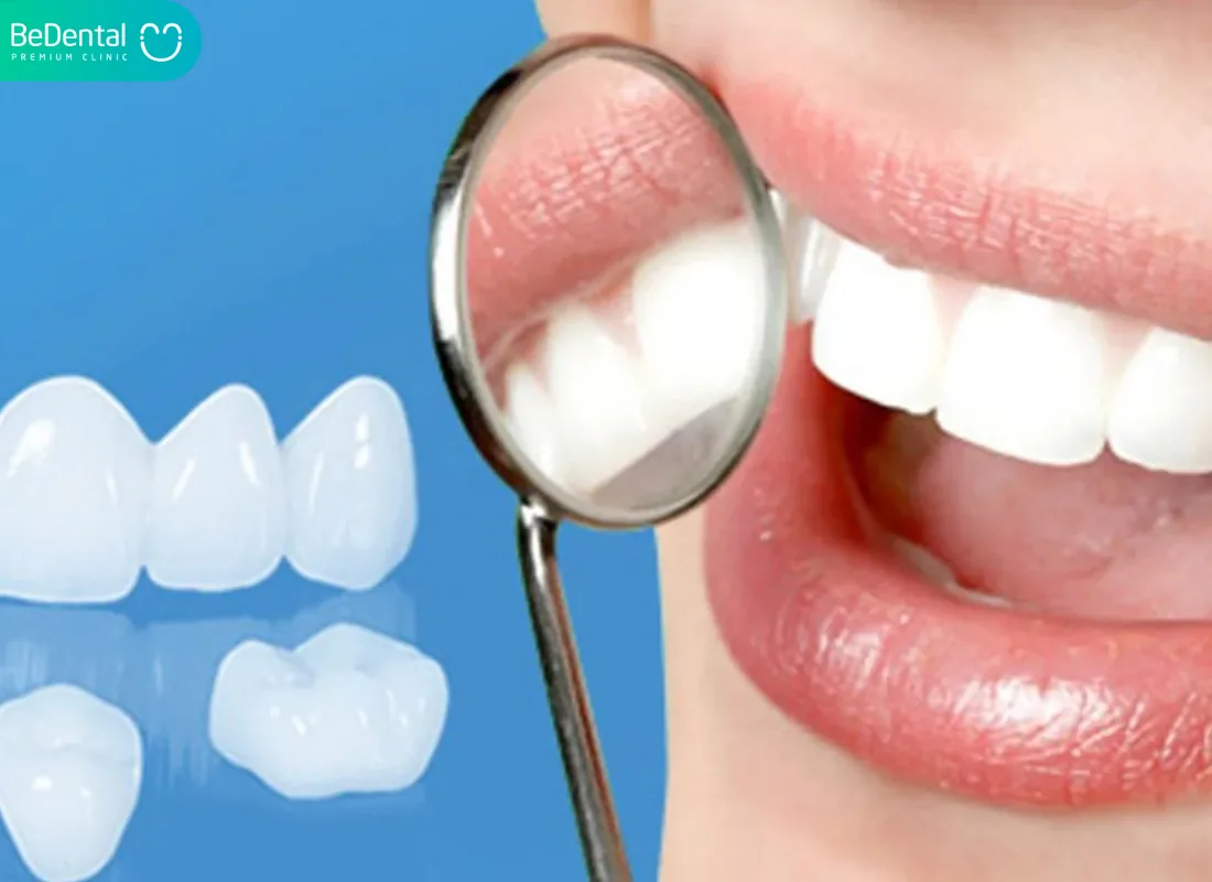 Emax Porcelain Teeth in Vietnam