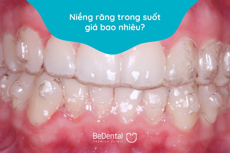 niềng răng invisalign giá bao nhiêu
