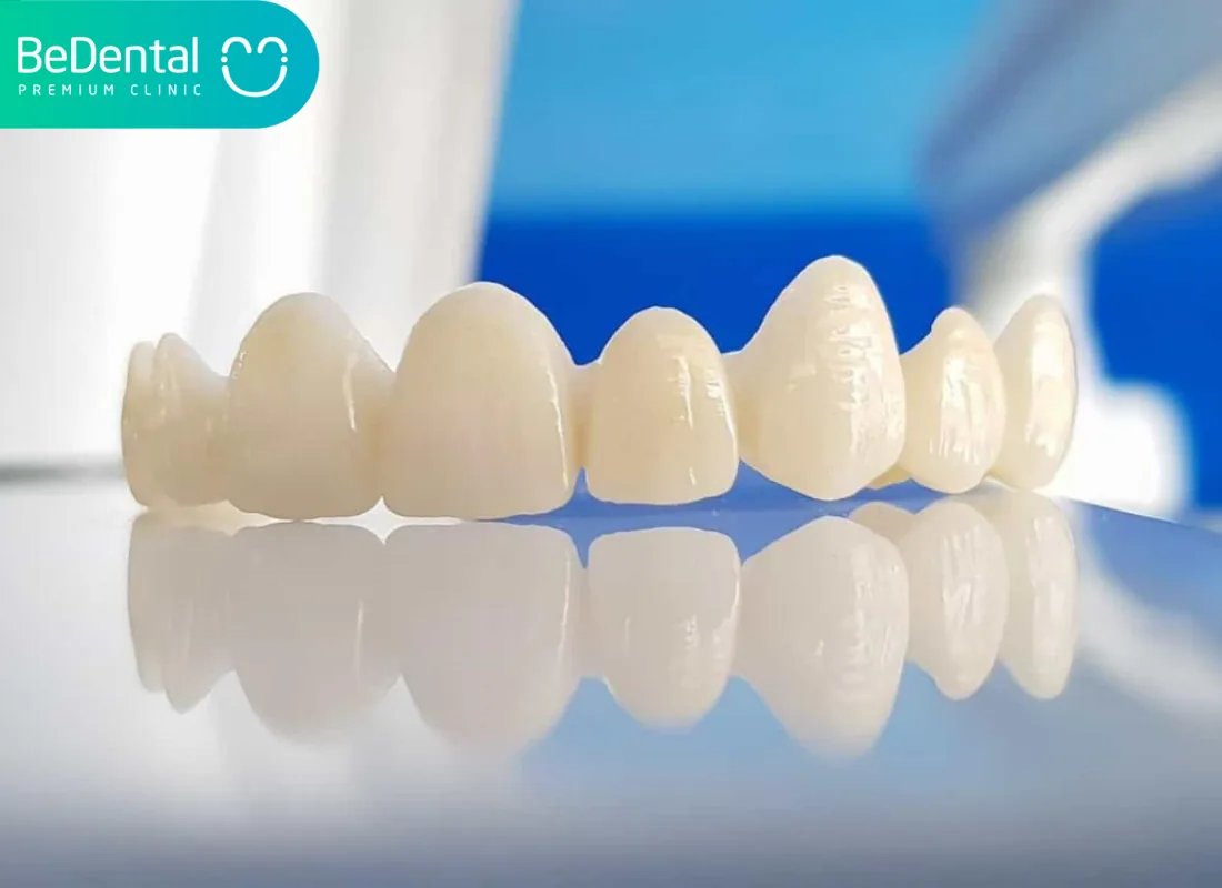 Emax Porcelain Teeth in Vietnam