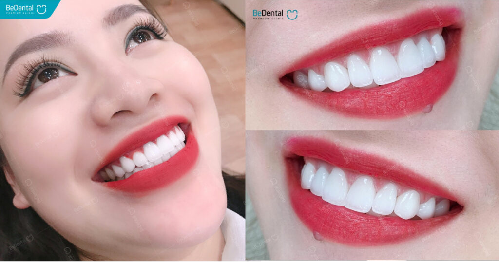 dental veneers vietnam