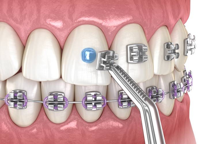 Braces Treatment Duration in Vietnam — What to Expect and How to Plan 5 braces illus
