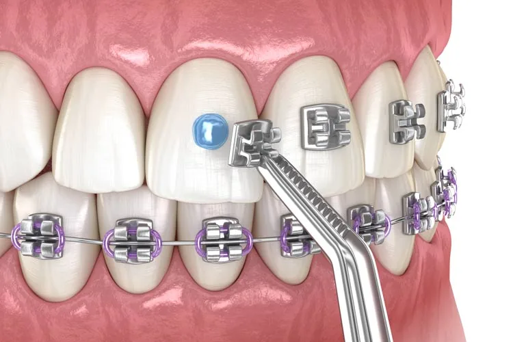 Best Age for Braces in Vietnam