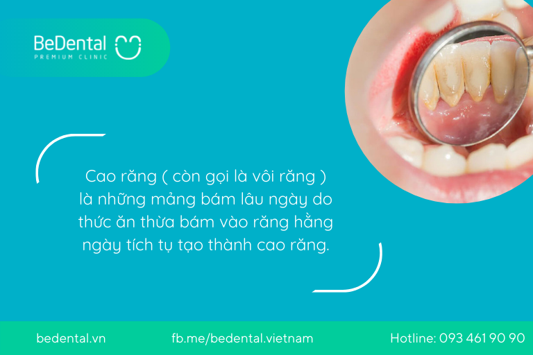cạo vôi răng lấy cao răng tại bedental