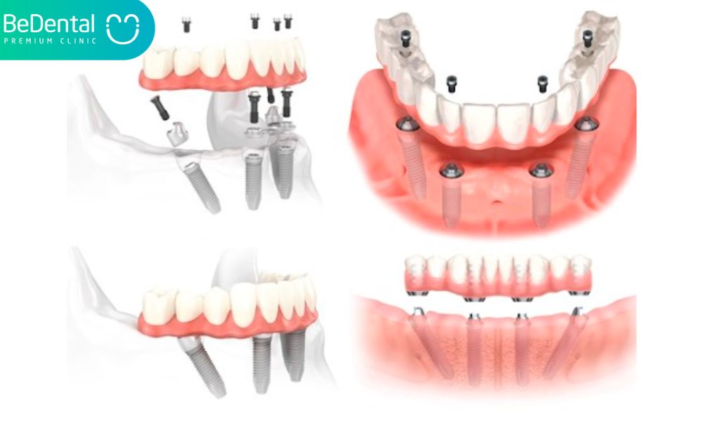 phục hình implant toàn hàm all-on-4