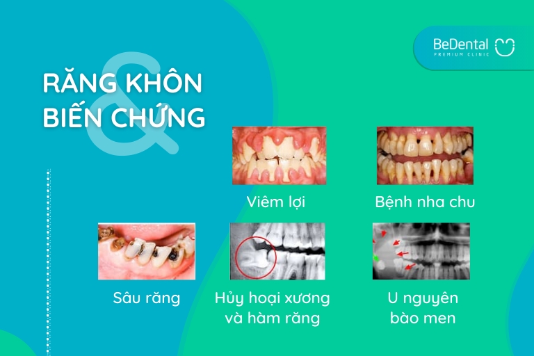 các trường hợp nhổ răng bệnh lý thường gặp