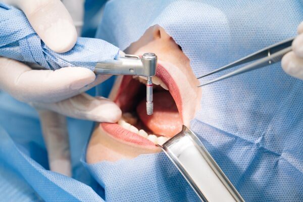 Orthodontic Mini-Screws (TADs) in Vietnam